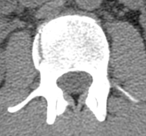 L2 Fracture L2 Fracture